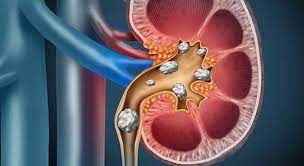 Best Kidney Stone Doctor